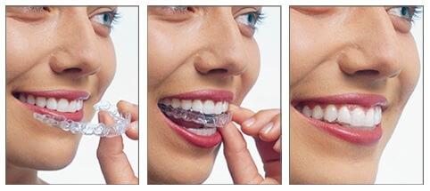 Traitement invisalign rabat agdal
