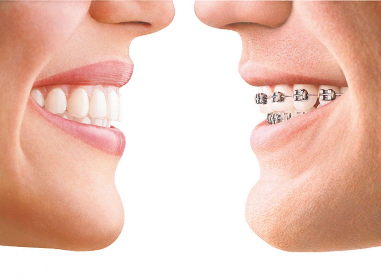 Traitement invisalign